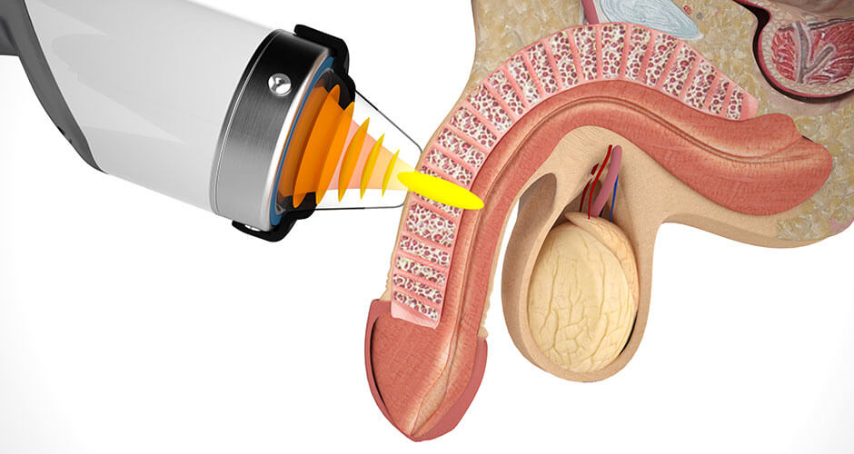 Extracorporeal Shockwave Therapy with Combined Exosomes for sexual performance