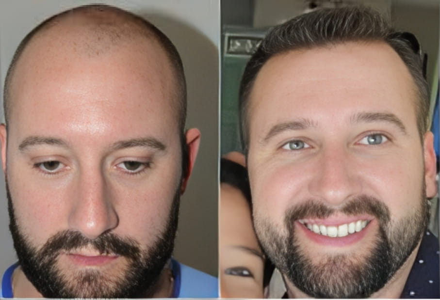 Hair transplant services