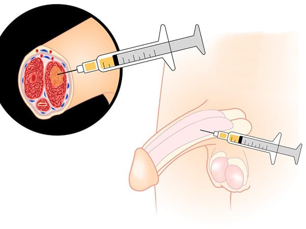 The Science Behind Extracorporeal Shockwave Therapy